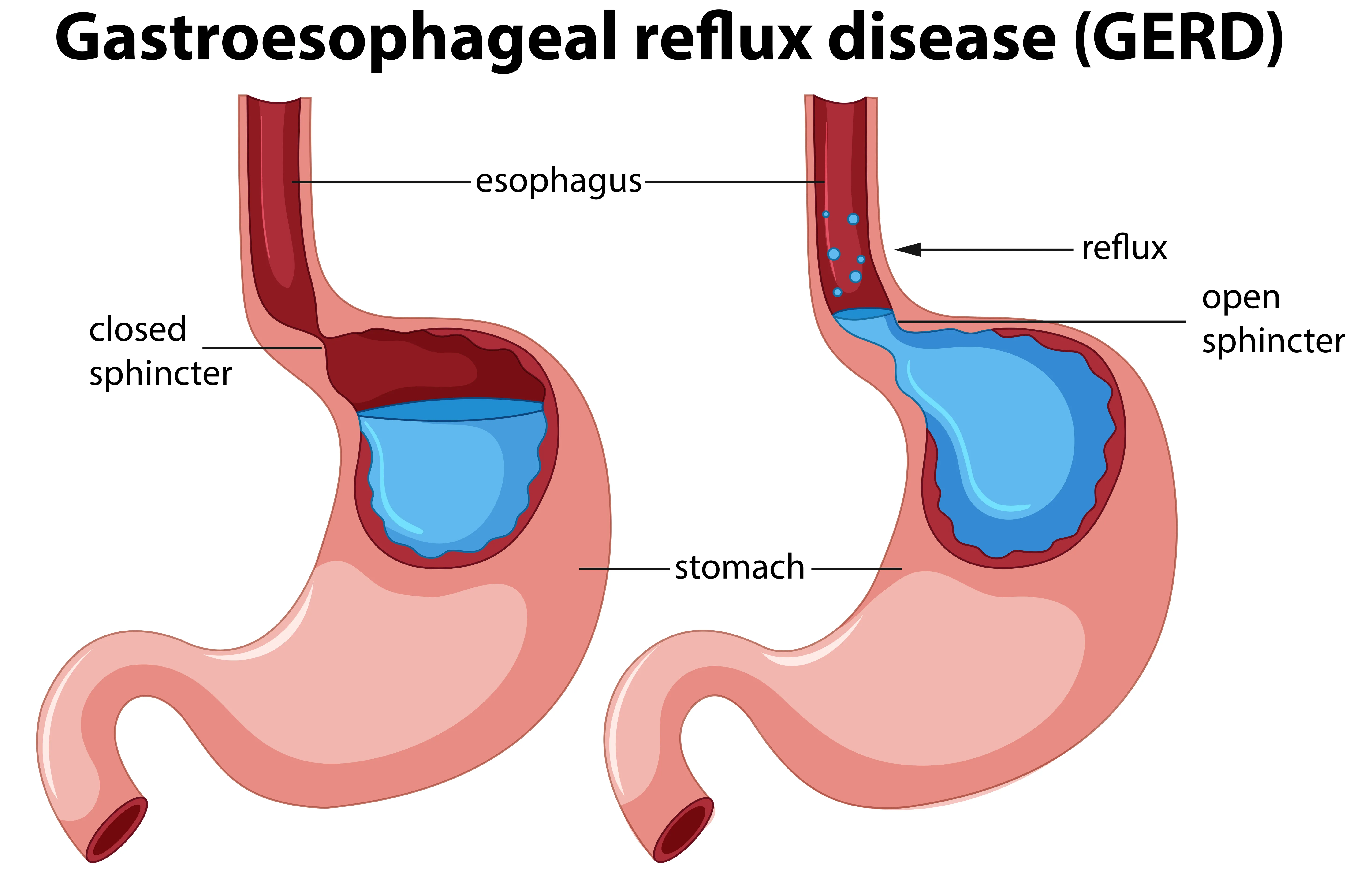 GERD mechanism